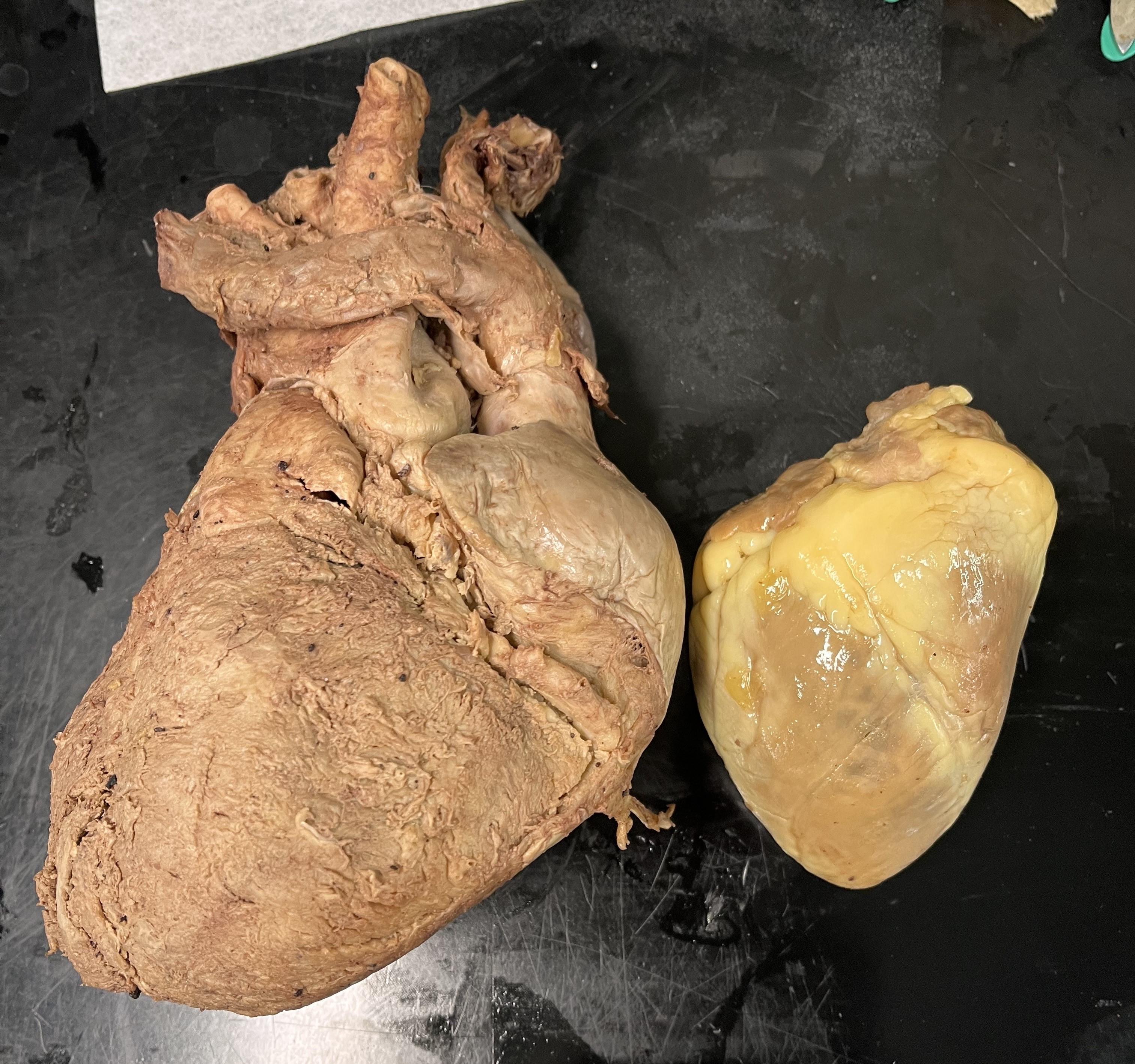 Enlarged Heart image